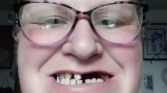 Žena neměla peníze na zubaře. Sama si tak vytrhala 13 zubů