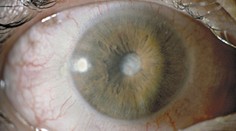 Zelený zákal vám nevratně poškodí zrak. Sami ho nepoznáte, varuje oftalmolog