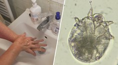 V Česku řádí svrab. Pacientů je nejvíce za posledních 30 let, čtyři zemřeli