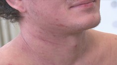 Dvouletý Čenda trpí od narození ekzémem. Pomoct může převratná léčba