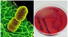 Super rezistentní bakterie zabíjela, nepomohlo 26 druhů antibiotik