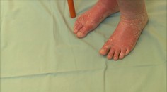 Lupénka trápí čtvrt milionu Čechů. Pomoct může hubnutí