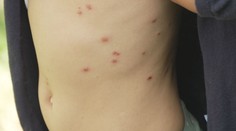 Plané neštovice se šíří Českem. Nakazily se desítky tisíc lidí