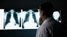 Rakovinu plic lidé odhalují pozdě. Lékaři upozorňují na tři nenápadné, ale zásadní příznaky