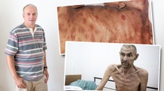 Pravá tvář AIDS: Muž promluvil o utrpení umírajících! SVĚDECTVÍ