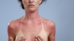 Jarní sluníčko spálilo Čechům záda i nosy. 20 RAD, jak kůži vyléčit