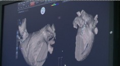 Čeští lékaři mají unikátní metodu: Při operaci vytvoří 3D obraz srdce!