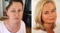 Dovolená v Česku jí zničila život i vzhled. Ženě (52) odstranili část lebky