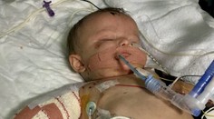 Dívenka trpí nejhorší meningitidou za 25 let! Amputovali jí nohy i ruce
