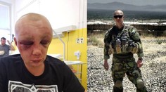 Mladého vojáka zkopali v Teplicích do bezvědomí. Praskla mu lebka!