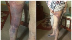 Lupič přepadl babičku (92) kvůli stovce! Utrpěla děsivá zranění