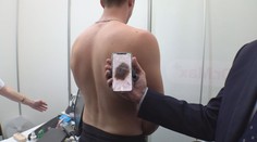 Rychlé a kvalitní vyšetření? Na rakovinu kůže vás může upozornit aplikace