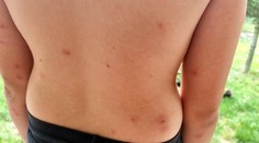 Štěnice pokousaly děti na letním táboře na Děčínsku. Řeší to hygiena
