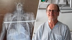 Trhal třešně, spadl a obě plíce mu propíchla tyč. Lékaři mu otevřeli hrudník