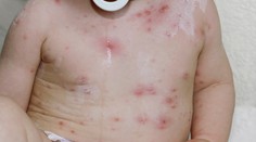 V Evropě jsou opičí neštovice! Vakcína není, lékaři děsí pandemií