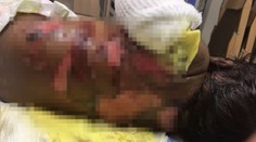 Máma nemůže své dítě obejmout! Chlapeček trpí, ztratil většinu kůže