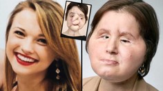 Dostala druhou šanci! Kráska se střelila do obličeje, už má nový