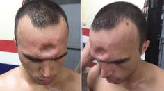 Thaiboxer skončil s dírou v čele, přesto chtěl zápasit dál!