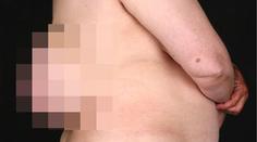 Ženě vyrostlo na zádech "třetí prso"! Nechala ho růst 10 let