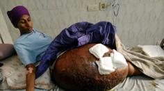 Hrůza! Tohle měl mladík osm let na noze. Nádor vážil víc než on