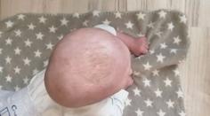 Obří boule na hlavě ničí miminku život. Ortézu pojišťovna neproplatí