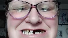 Žena neměla peníze na zubaře. Sama si tak vytrhala 13 zubů