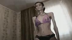 Dívka (23) přestala jíst po rozchodu! Nyní váží už jen 21 kilo