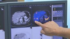 Lékař varuje před přehlíženou rakovinou. Jeden symptom nesmíte ignorovat