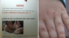 Ničí jim ruce! Na Slovensku zasáhla děti podivná choroba