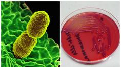 Super rezistentní bakterie zabíjela, nepomohlo 26 druhů antibiotik
