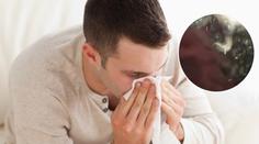 Muže bolela hlava. Našli mu v ní tucet červů, kteří ho zachránili