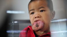 Má třikrát větší jazyk! Malý chlapec (4) nemůže ani jíst