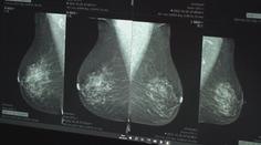 Případů rakoviny přibývá, čísla jsou alarmující. Lidé podceňují preventivní prohlídky