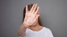 Epidemie spalniček na vzestupu. Kdo je nejvíc v ohrožení?