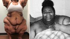 Musíte vidět: Nejtěžší žena světa shodila 200 kilogramů! GALERIE