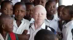 V Malawi vraždí albíny. Lidé věří, že má jejich tělo magickou moc