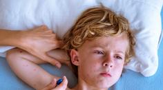 Spalničky se v Česku dál šíří! V Praze za týden onemocnělo 14 lidí