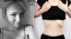 Dívka vážila jen 39 kilo! S anorexií se poprala skvělým způsobem