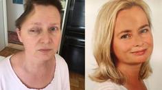 Dovolená v Česku jí zničila život i vzhled. Ženě (52) odstranili část lebky