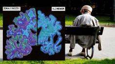 Tajemství Alzheimera? Vědci už ví, která látka nemoc rychle zhoršuje
