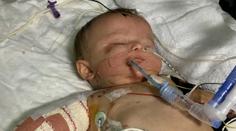 Dívenka trpí nejhorší meningitidou za 25 let! Amputovali jí nohy i ruce