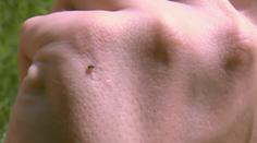 Nakažených kvůli klíšťatům dál přibývá! "Bude hůř," tvrdí epidemiolog
