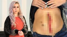 Hrůzný případ: Dívce praskla jizva, viděla si do žaludku! FOTKY