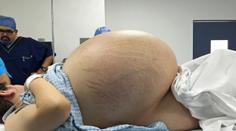 Žena nejedla, břicho jí ale rostlo! Lékaři vyoperovali 33kilový nádor