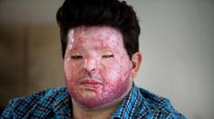 Chtěl pomstít příbuzného a polil muže kyselinou. Spletl si ale dům