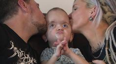 Emilek (3) trpí vzácným syndromem. Deformuje mu lebku, má za sebou spoustu operací