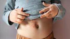 Hygienici bijí na poplach! V ČR přibývá počet případů onemocnění svrabem