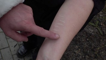 Nože nebo nůžky. Desítky tisíc dětí se sebepoškozují, jejich počet strmě roste