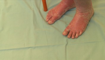 Lupénka trápí čtvrt milionu Čechů. Pomoct může hubnutí