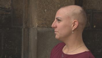 Lidí s alopecií přibývá. Na léčbu pojišťovny moc nepřispívají